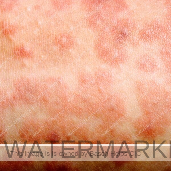 Measles is highly infectious. 1 person can infect 15 other unvaccinated people on average.