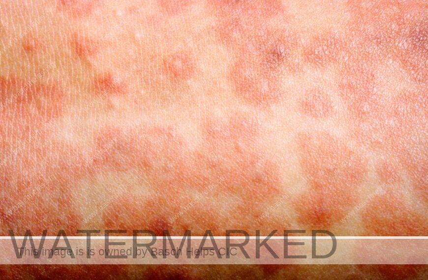 Measles is highly infectious. 1 person can infect 15 other unvaccinated people on average.